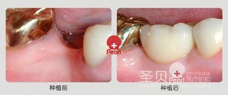 单颗牙缺失 圣贝种植系统为您解忧