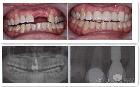 多颗缺失治疗前后对比