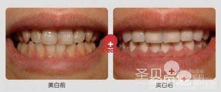 黄牙---圣贝美牙案例