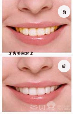 圣贝系统治疗四环素牙案例