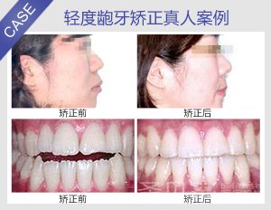 轻度龅牙矫正真人案例