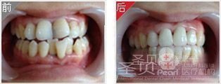 牙齿拥挤美容冠修复案例