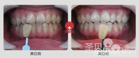 圣贝亲贝美牙系统 重回挑战未来的信心