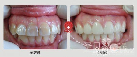 圣贝亲贝定制牙美容技术让您重拾笑容