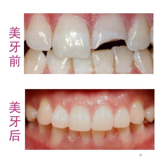 英语老师的牙齿修复之路