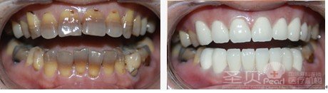 四环素牙的克星 cerec5D美牙无阻力