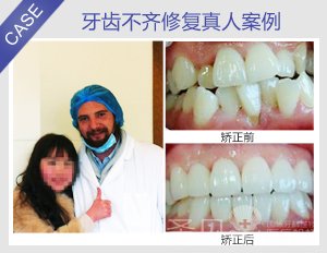 牙齿不齐修复真人案例