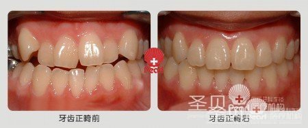 牙列拥挤 圣贝美颜正畸让牙齿悄悄立正