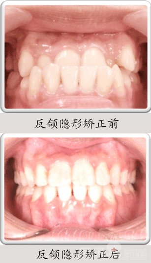 反颌矫正 圣贝美颜正畸事业最佳帮手