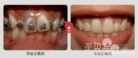 深覆合矫正 让您笑得更加自然