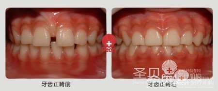 牙缝大成功矫正案例