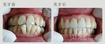 深覆合牙齿正畸案例