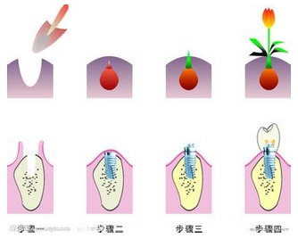 种植牙的过程
