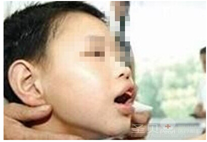 老鼠牙的原因