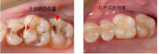 补牙疼吗