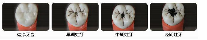 蛀牙不是小问题