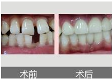 镶牙的注意事项
