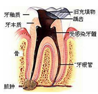 根管治疗后应该注意的事项