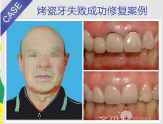 烤瓷牙可以换吗