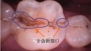 牙齿有裂纹的危害
