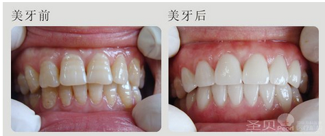 西安美白咖啡牙哪家好