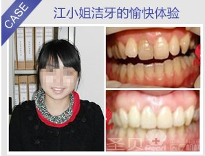 怎样祛除牙结石