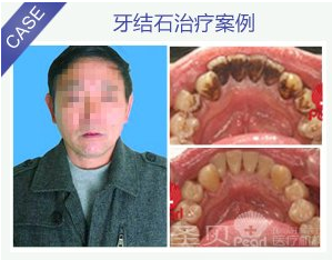 经常洁牙好不好