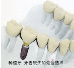 什么症状适合种植牙