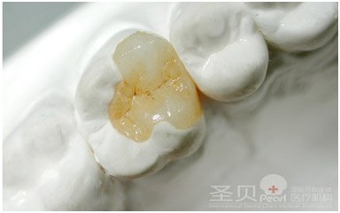 全瓷嵌体好吗