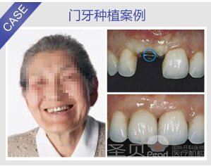 牙齿缺失要怎么修复