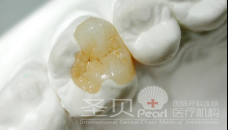 补牙的方法有哪些