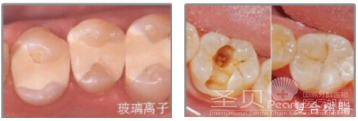 补牙的方法有哪些