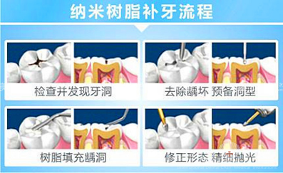 补牙的方法有哪些