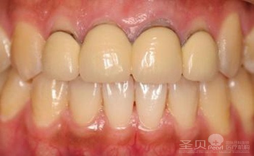烤瓷牙导致牙龈发黑的原因
