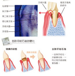 怎么治疗牙龈萎缩