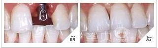 种植牙修复