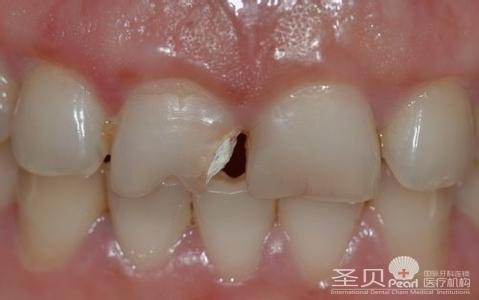 烤瓷牙掉了一块怎么办