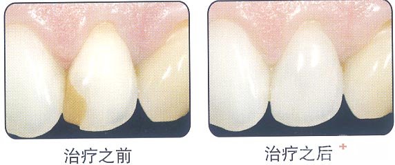 烤瓷牙掉了一块怎么办