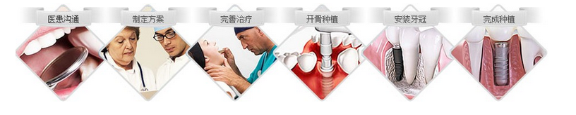 种植牙需要多少时间