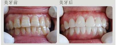 不同程度的四环素牙怎么治疗
