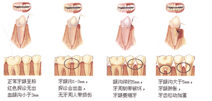 牙齿松动怎么办