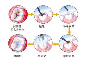 窝沟封闭全攻略