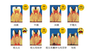 儿童龋齿要怎么治疗