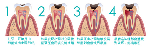 蛀牙怎么治疗