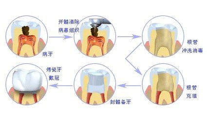 蛀牙是拔还是补好