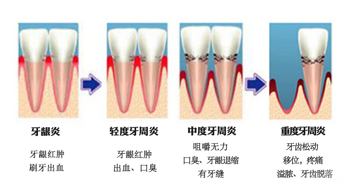 牙周炎要怎么治疗