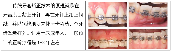 牙套矫正有哪些种