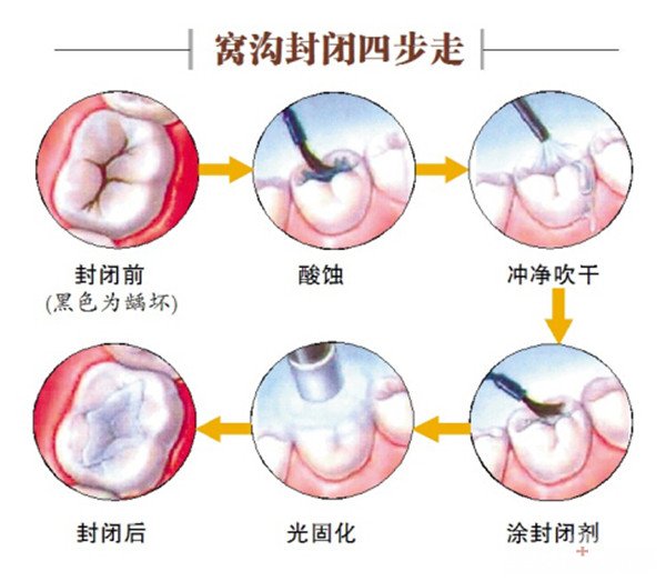 西安儿童做窝沟封闭多少钱