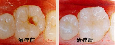 补牙要多长时间