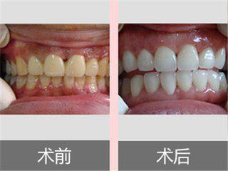 牙齿美白全攻略